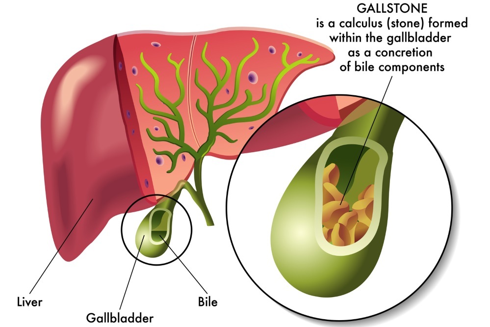 Natural Cure for Gallstones